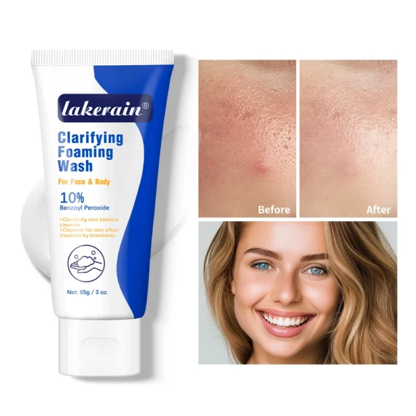 Acne Foaming Wash Benzoyl  For Face & Body Skin Care Wash